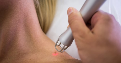 Skin Tags Removal