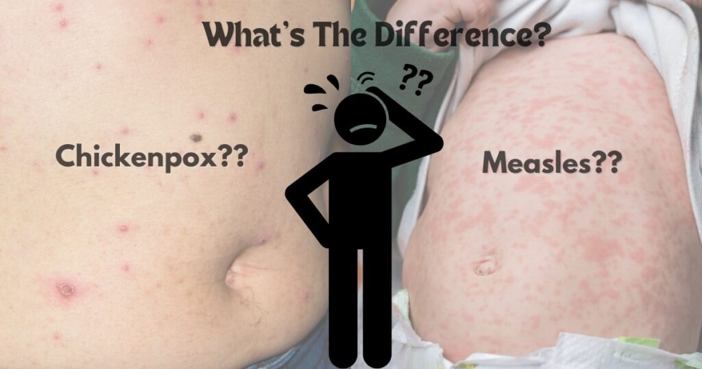 difference between measles and chickenpox