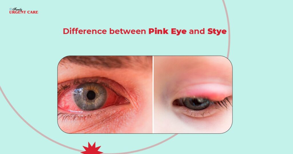 difference between pink eye and stye